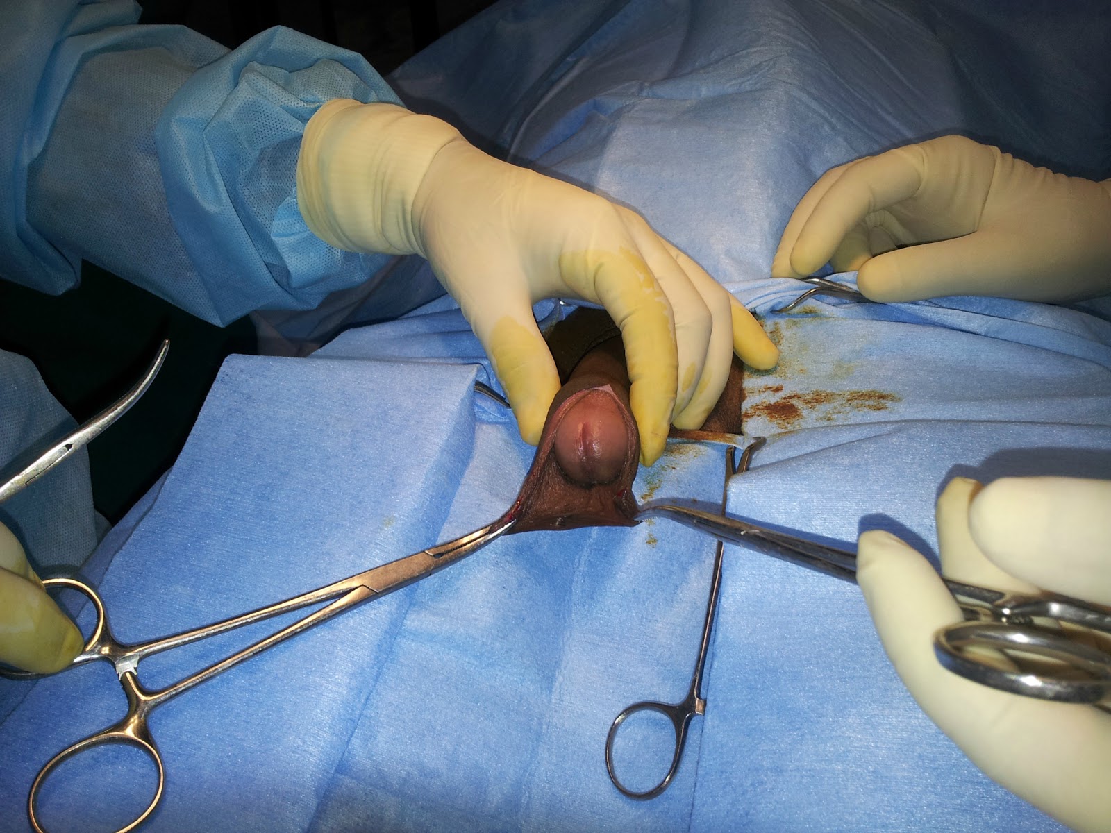 Férfi intimplasztika, pénisznagyobbítás - dr. Pataki Gergely plasztikai sebész